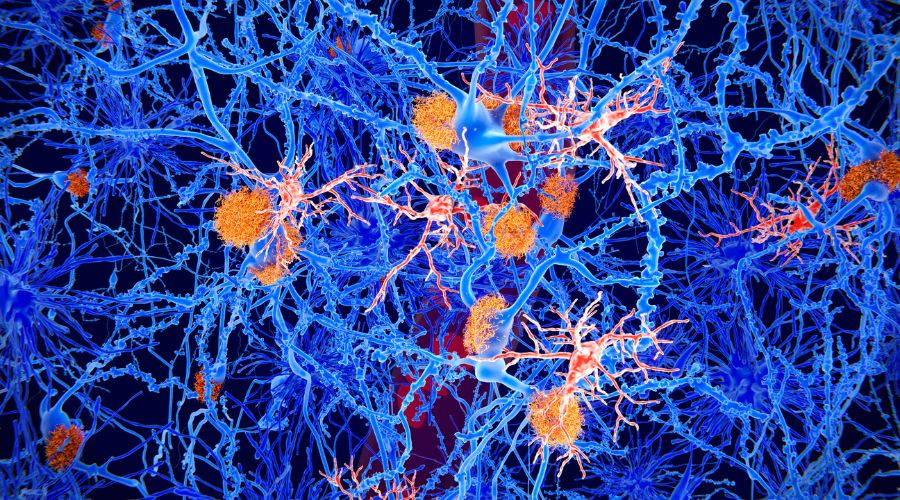 amyloid plaques in alzheimer's disease